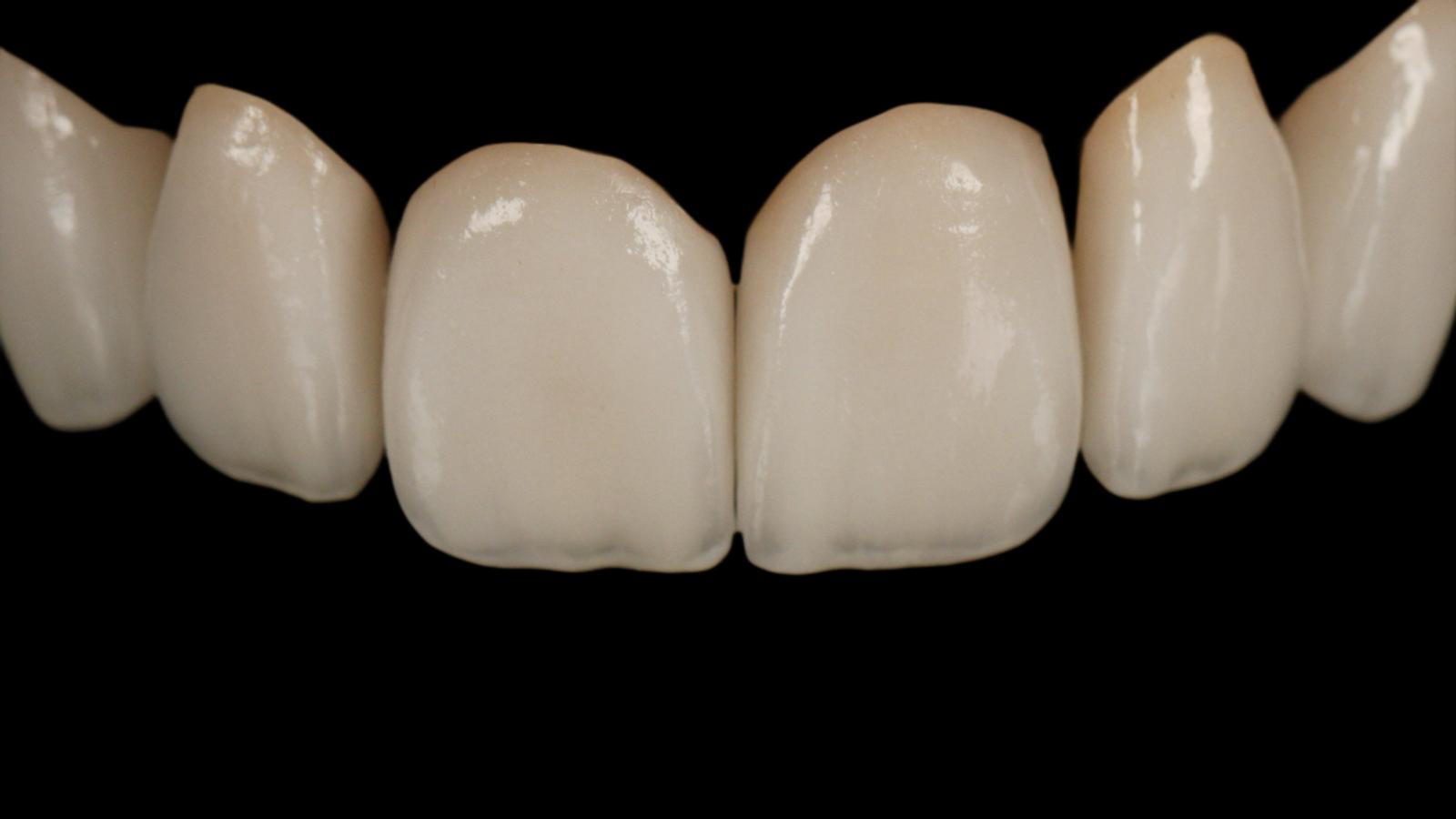 Carillas y estética anterior