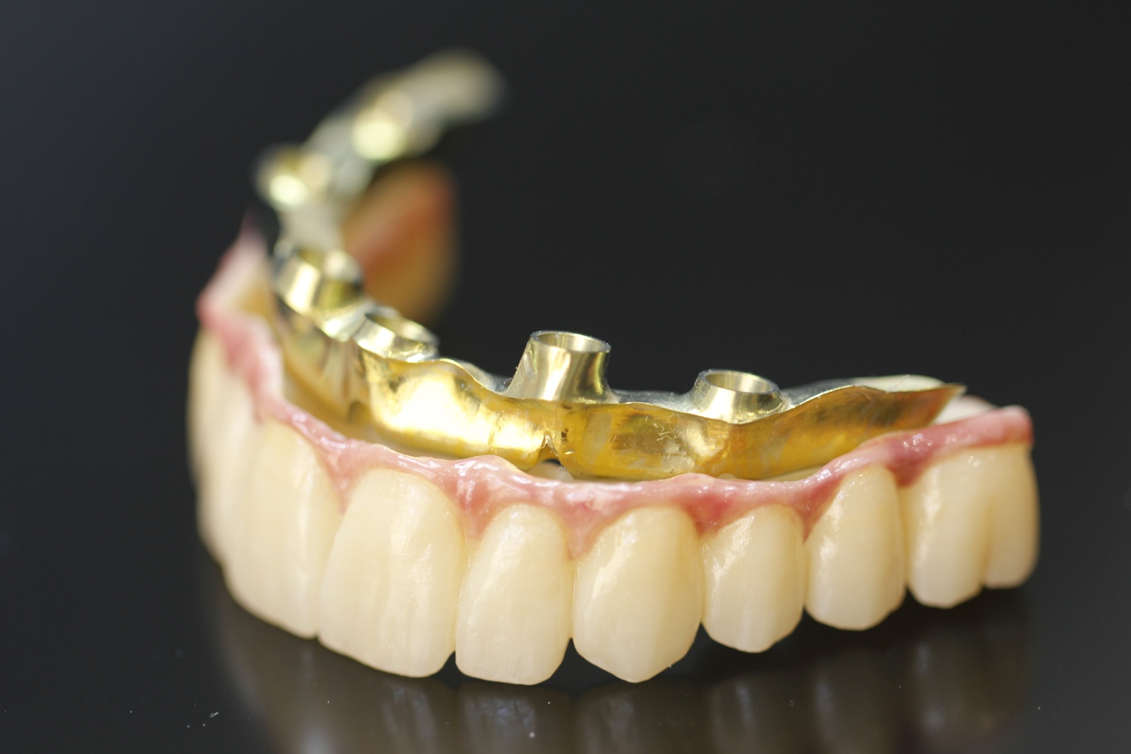 Rehabilitaciones completas sobre implantes