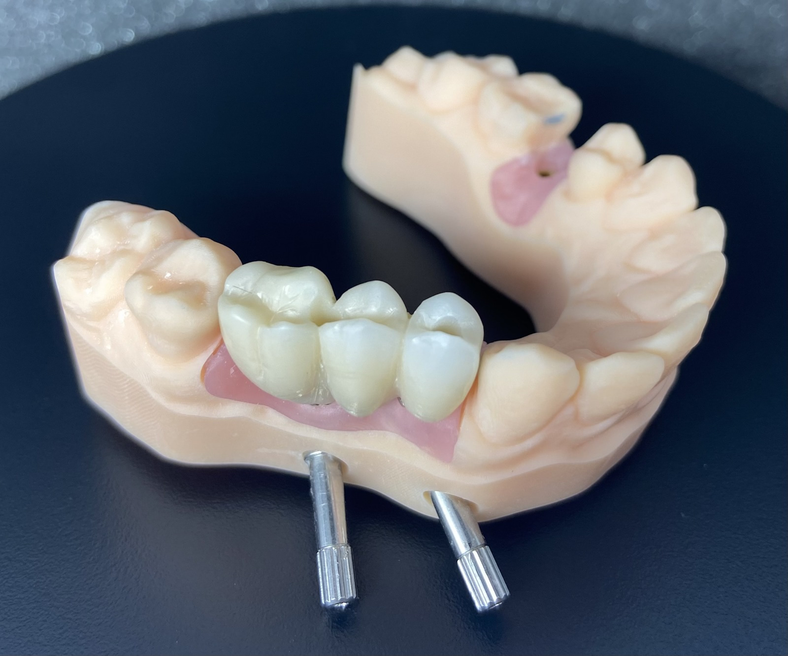 Prótesis fija sobre implantes